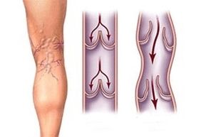 odol-irteera barizeetan gaixotasunaren garapen-fase desberdinetan